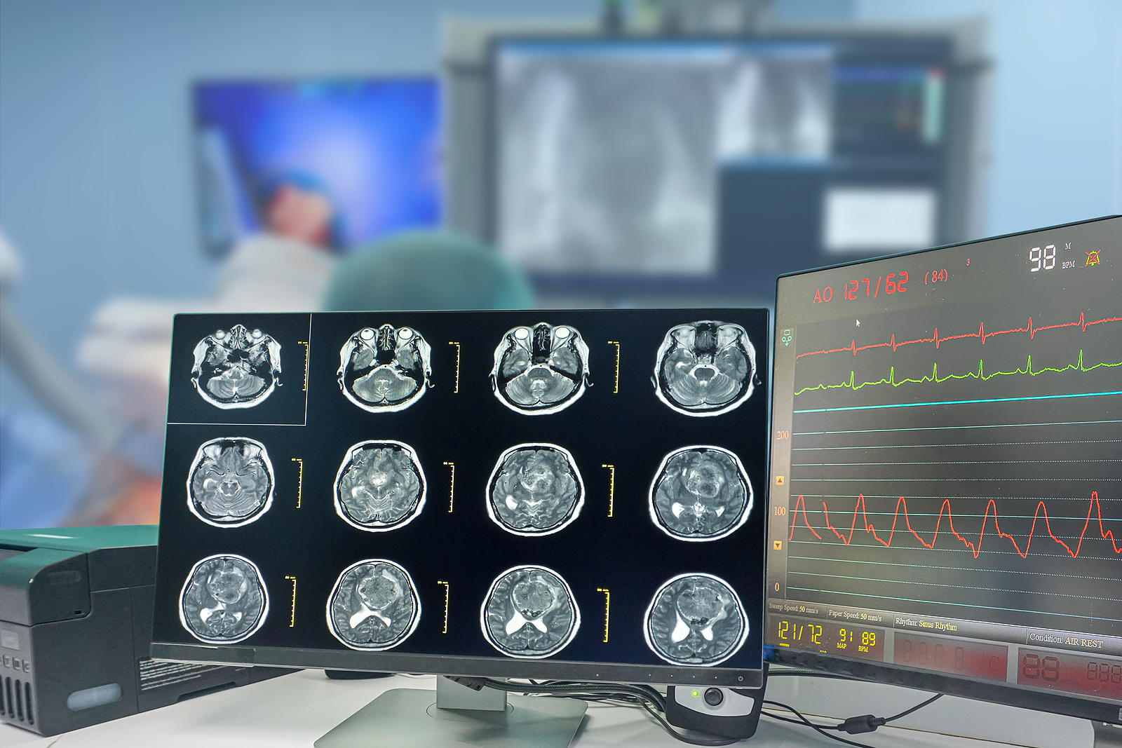 How New Treatment Options May Help Glioblastoma Patients