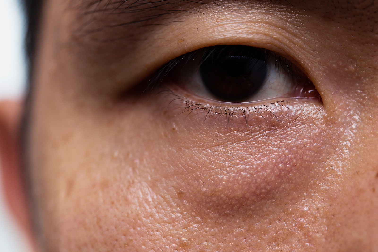 What Causes Droopy Eyelids And How Can They Be Treated?