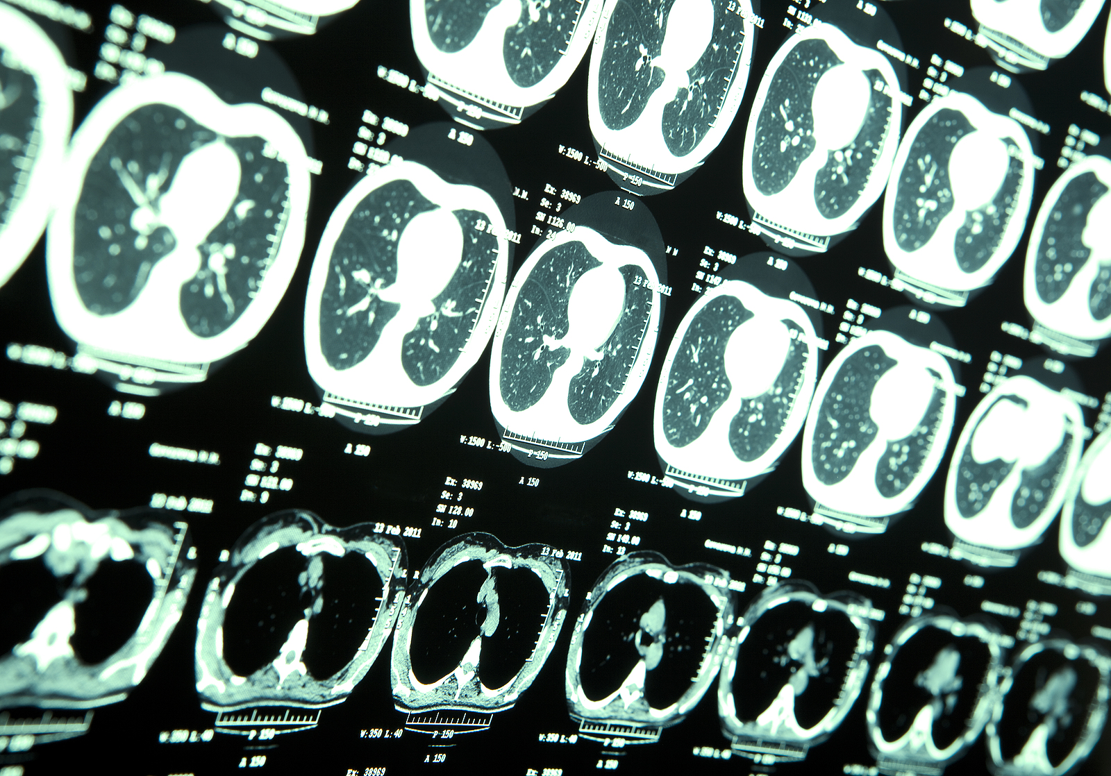Why Is Gamma Knife Surgery Used To Treat Brain Tumours?