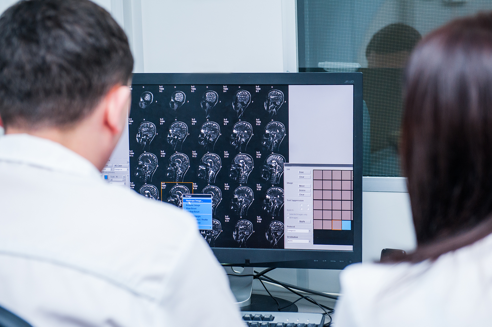 Can More Personalised Care Improve Glioblastoma Treatment?