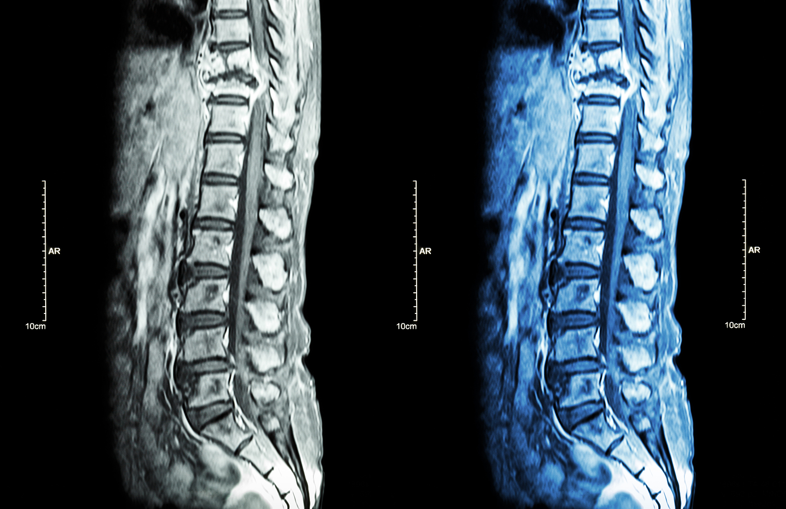 What Is Metastasis And Can it Affect Brain Tumour Treatment?