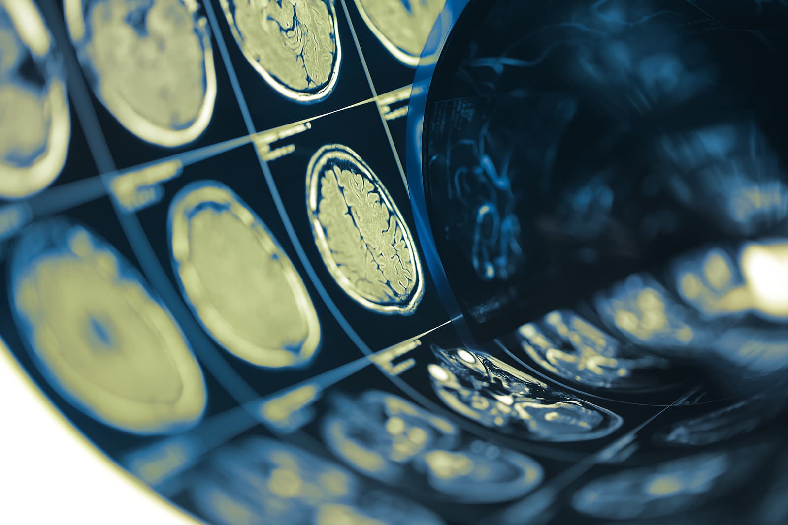 What Is The Difference Between Glioblastoma, Astrocytoma And Oligodendroglioma?