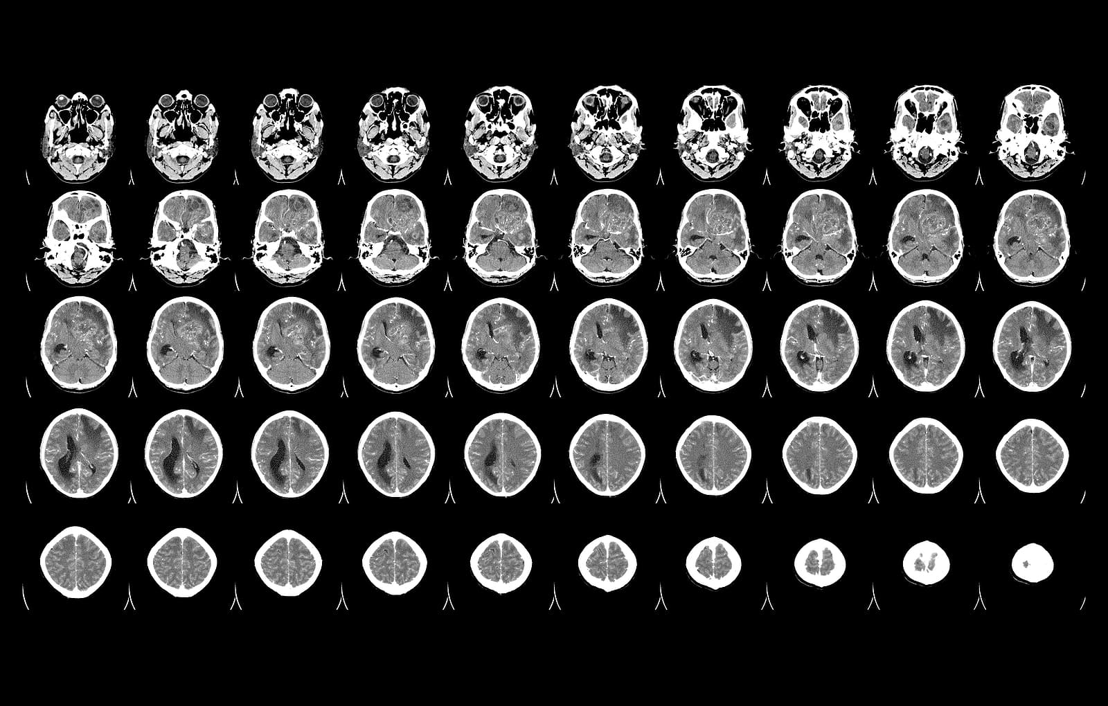 When Is A Meningioma Discovered Incidentally?