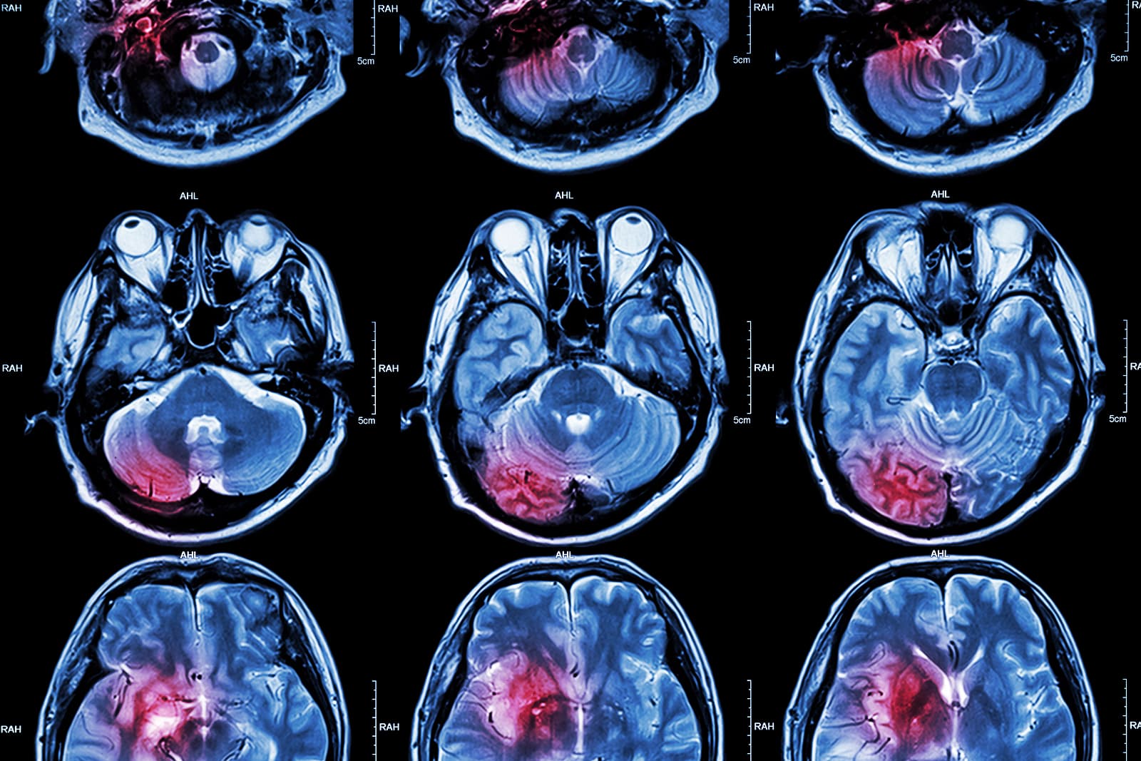 Understanding WHO Brain Tumour Classifications