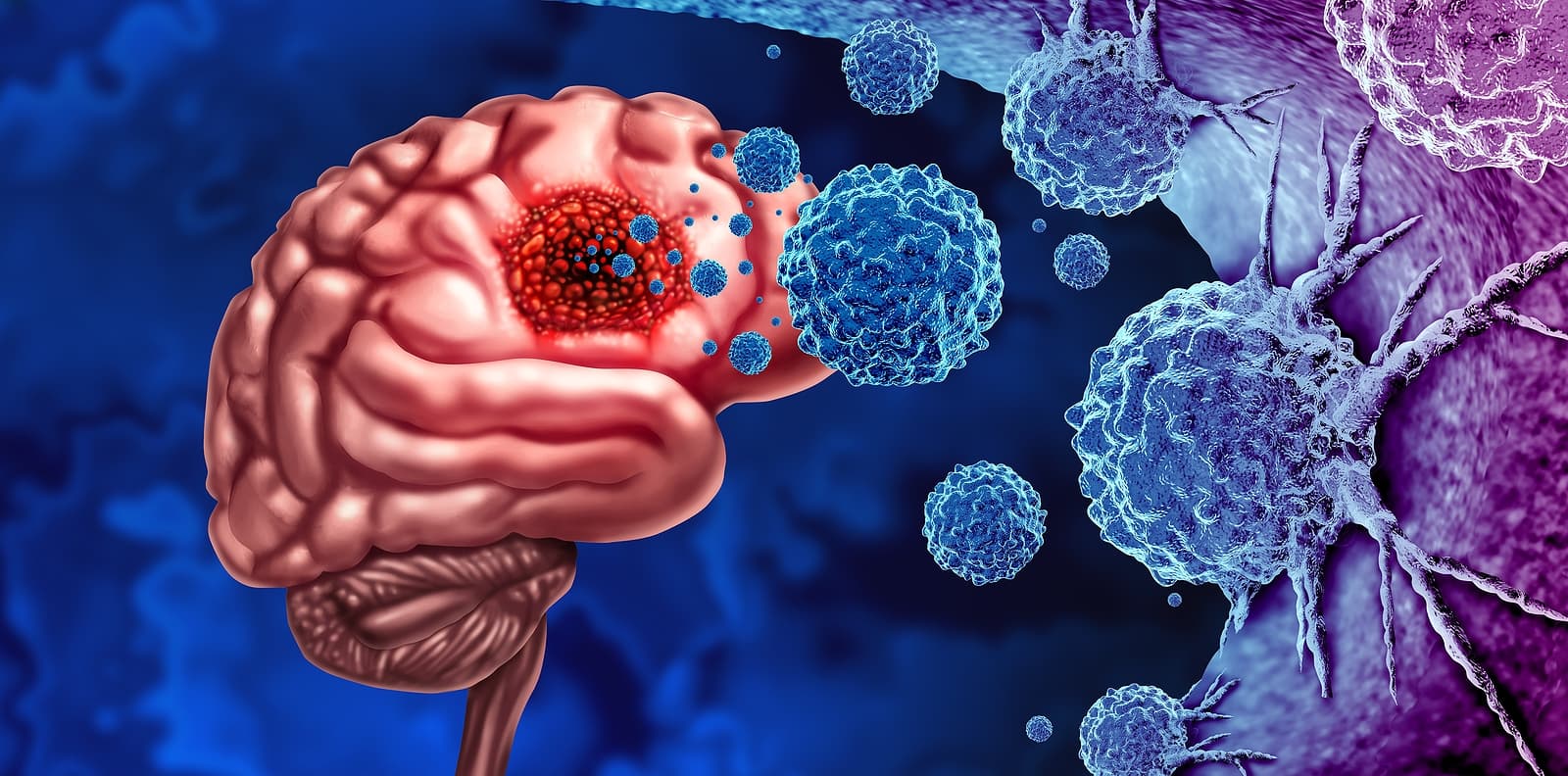 When Should You Consider A Second Opinion For Glioblastoma?